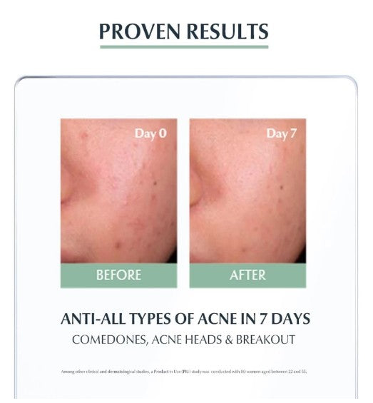 Shop Eucerin SOS Serum 40ml for pimples at SaffronSkins – anti-acne solution from Dubai