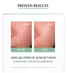 Shop Eucerin SOS Serum 40ml for pimples at SaffronSkins – anti-acne solution from Dubai